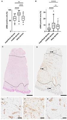 Myofibroblasts reside in the middle dermis of the keloids but do not predict the response to injection therapies: a double-blinded, randomized, controlled trial